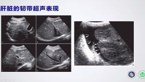 肝脏常见疾病的超声诊断